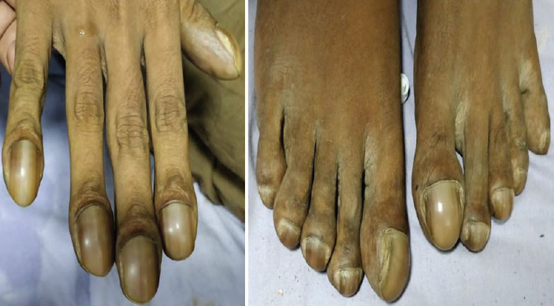 Grade-3 clubbing with parrot-beak appearance of the fingers and toes.
